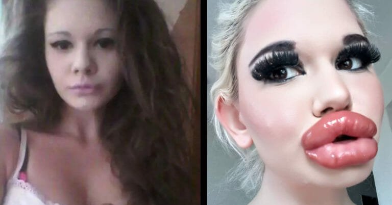 24-year-old woman wants the biggest lips in the world