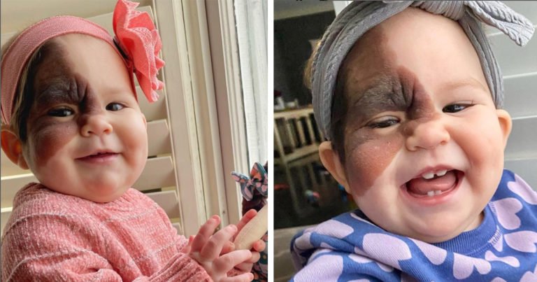 Mom wants daughter with rare birthmark to know she’s beautiful