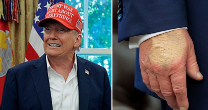 Alarming photo of Trump’s hand sparks deep concern